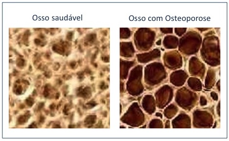 osso com osteoporose