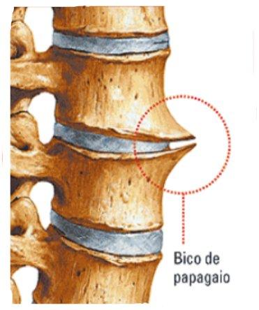 Bico de papaio na coluna ou Osteofitose: guia completo | Dr. Rodrigo Yunes